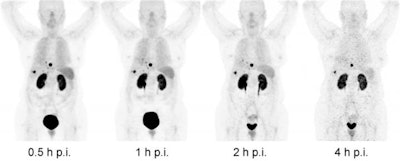 PET images with Ga-68 OPS202 show that tumor and renal uptake persist over time while organs such as the spleen, lungs, and liver, along with the urinary excretion, are progressively washed out. The highest tumor contrast was found one hour after injection. Images courtesy of JNM.