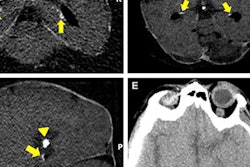 2018 06 11 23 15 3406 Ct Hippocampal Calcification 20180611233159