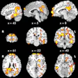 2018 06 12 02 07 2497 Kids Ckd Brain Regions Detre 20180612021746