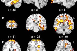 2018 06 12 02 07 2497 Kids Ckd Brain Regions Detre 20180612021746