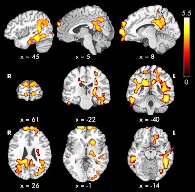 ASL-MRI maps show regions of the brain in which cerebral blood flow was greater in patients with chronic kidney disease than normal subjects. The areas (red, yellow, and orange) are associated with cognitive function. Image courtesy of Radiology and RSNA.