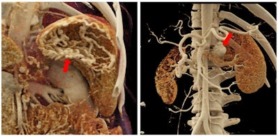 Cinematically rendered images of a stomach with extensive varices (left) and a relatively large saccular aneurysm near the left renal artery (right). Images courtesy of Dr. Elliot Fishman.