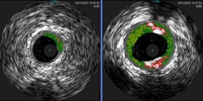 Cross-sectional IVUS images of coronary arteries. Plaque buildup (colored areas) in an artery from a patient who lacks sensitivity to the red meat allergen (left) is much lower than plaque levels in an artery from a patient with sensitivity to the allergen (right). Images courtesy of Dr. Angela Taylor of the University of Virginia Health System.