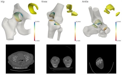 The joint space mapping algorithm measures the space between joint bones on 3D CT scans. Image courtesy of Dr. Tom Turmezei, PhD.