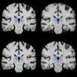 2018 06 19 22 17 2727 Brain Mri Registration 20180619221642