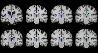 A machine-learning algorithm, VoxelMorph, can register brain MRI scans more quickly than standard techniques can. Image courtesy of Adrian Dalca, PhD, and colleagues at MIT.