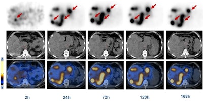 SPECT/CT shows a 45-year-old man with advanced NETs and multiple liver metastases. Scans were performed at two, 24, 72, 120, and 168 hours after the administration of Lu-177 DOTA-EB-TATE. The radiopharmaceutical cleared from the blood pool over time and was retained in the tumors (arrows). Images courtesy of Zhang et al and SNMMI.