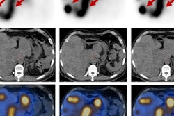 2018 06 24 19 18 7030 Lu 177 Dota Eb Tate Net Tumors 20180624195346