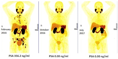 Persistent complete remission on long-term follow-up after early Lu-177 PSMA radioligand therapy. Lymph node and osseous metastatic, castration-resistant, and chemotherapy-naive prostate cancer in a 62-year-old patient demonstrated no evidence of disease on Ga-68 PSMA PET/CT eight months (center) and 17 months (right) after first PRLT treatment. Image courtesy of Dr. Harshad Kulkarni et al, Theranostics Center for Molecular Radiotherapy and Molecular Imaging at Zentralklinik Bad Berka in Germany.