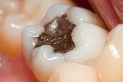 2018 06 25 23 48 1854 Amalgam Filling 400