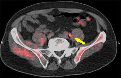 Fused fluciclovine-PET/CT image indicates recurrent prostate cancer (arrow) in a pelvic lymph node. Image courtesy of Dr. Barry Seigel, Mallinckrodt Institute of Radiology, and SNMMI.