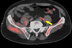 2018 06 26 18 10 2725 2016 06 26 Fluciclovine Prostate Pet 400