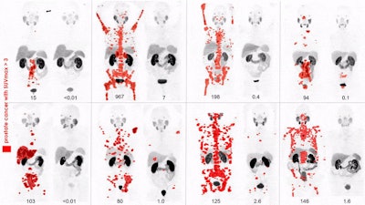 Ga-68-PSMA-11 images were acquired before and after lutetium-177 PSMA617 treatment in eight patients with metastatic prostate cancer who had exhausted standard therapeutic options. PET maximum intensity projection (MIP) images indicate PSA decline of 98% or greater. Disease is identified in red areas, indicating standardized uptake values higher than 3. Images courtesy of Hofman et al, Peter MacCallum Cancer Centre in Melbourne, Australia, and SNMMI.
