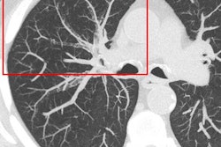 2017 06 06 10 57 35 382 2017 06 06 Bronchiolitis2 Hri Prokop 400