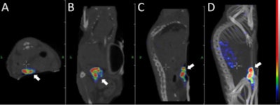 Transversal (A), coronal (B), and sagittal (C) nanoSPECT/CT and maximum intensity projection (D) images were acquired 30 hours after injection of pretargeted radionuclide therapy. The tumor (arrow) was located on the abdomen. Images courtesy of Uppsala University and JNM.