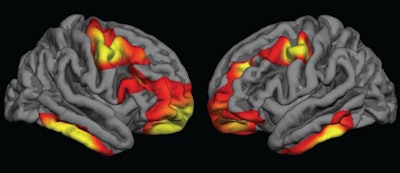 Colored areas indicate regions of the cerebral cortex that are significantly thicker in children who were exposed to folic acid fortification during pregnancy, compared with those who were not exposed. Images courtesy of Dr. Joshua Roffman.