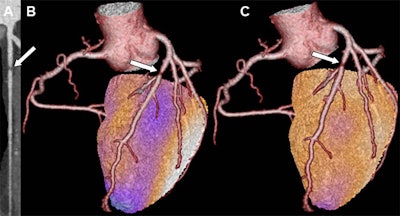 Multiplanar contrast-enhanced coronary CT angiography reconstruction shows a stenosis in the proximal left anterior descending artery (A). Cardiac hybrid imaging fuses coronary CT angiography with SPECT myocardial perfusion imaging, showing a matched perfusion defect in the same artery (B, C). Image courtesy of RSNA.