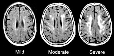 MRI scans show damage to the brain's white matter. Images courtesy of the Gottesman Lab.