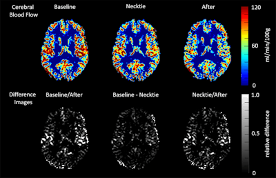 MR images show changes in cerebral blood flow in healthy volunteers before, during, and after wearing a necktie. Courtesy of Dr. Robin Lüddecke.