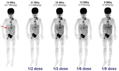 Maximum intensity projection (MIP) images from a 4-year-old patient highlight (arrow) one of three lesions. Researchers reconstructed TOF PET images down to 11% of the standard dose. While the image quality worsens, lesion conspicuity remains relatively stable at one-third the dose. Images courtesy of Jeffrey Schmall, PhD.