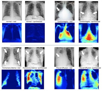 On the left of each quadrant is a real x-ray image of a patient's chest; beside it is the synthesized x-ray formulated by the DCGAN algorithm. Under the x-ray images are corresponding heatmaps, which is how the machine learning system sees the images. Image courtesy of Hojjat Salehinejad of MIMLab.