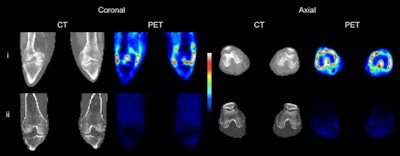 CT and C-11 PBR28 PET of both knees of (i, top row) an RA patient with clinical signs of synovitis in both knees and (ii, bottom row) a healthy control. Images courtesy of Narayen et al and JNM.