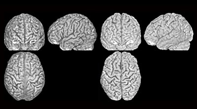 Three MRI scans (front, side, and above) of two different brains (left and right) that belong to twins. The furrows and ridges differ between the two people. Image courtesy of Lutz Jäncke, PhD, University of Zurich.