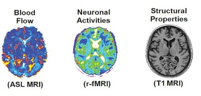 Multiple modes of PET and MRI were used to create personalized brain 'fingerprints.' Image courtesy of Yasser Iturria-Medina, PhD.