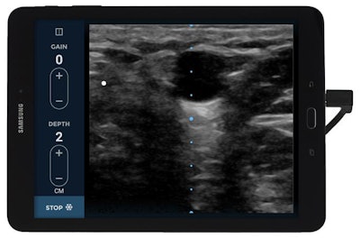 EchoNous Vein is designed to help with the insertion of peripheral IV catheters. Photo courtesy of EchoNous.