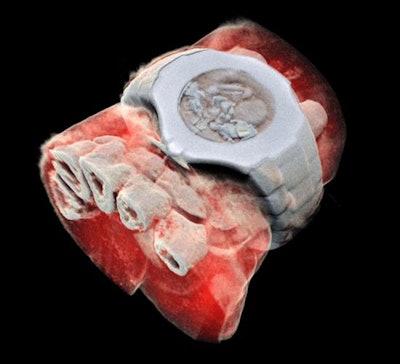 A 3D image of the wrist acquired with the Mars spectral CT scanner. Image courtesy of Mars Bioimaging.
