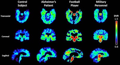 Warmer colors indicate a higher concentration of the tracer FDDNP, which binds to abnormal proteins in the brain. Image courtesy of UCLA Health.