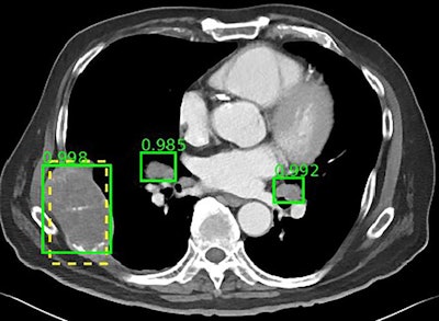 The NIH DeepLesion database includes more than 32,000 CT slices. Image courtesy of the NIH.