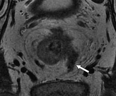 Above: MR image from a 55-year-old man with rectal cancer. Arrow indicates extramural venous invasion on T2-weighted image. Below: Rectal cancer in a 70-year-old man is evident (arrows and dotted line) using circumferential resection margin involvement on T2-weighted image. Images courtesy of AJR.