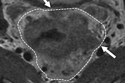 2018 07 30 19 47 9987 2018 07 31 Rectal Mri B 20180730194615