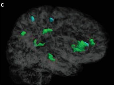 DTI-MR images show how significant differences in brain regions of women (green) and men (blue) associated with heading a soccer ball and fractional anisotropy. Image courtesy of Radiology.