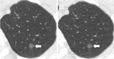 Standard dose CT (left) and ultralow-dose CT (right) provide comparable visibility of a left upper lobe ground-glass nodule that was missed by readers on the ultralow-dose CT scan but detected by CAD. Images courtesy of Dr. Chi Wan Koo.
