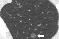 2018 07 31 21 53 8084 2018 08 01 Low Dose Ct Nodules 20180731215858