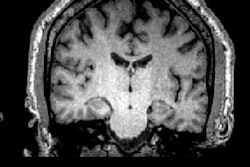 2018 08 08 17 33 4681 Jhrt Mri Dementia Willer 20180808175423