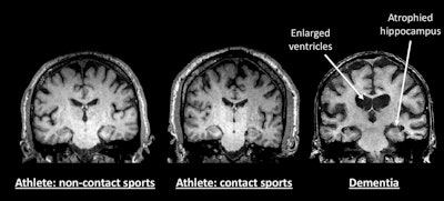 Neither the brain of a noncontact-sport athlete (left) nor the brain of a contact-sport athlete (center) show enlarged ventricles or atrophied hippocampus, both of which have been associated with dementia. For comparison, the MRI at right is of a person with dementia and shows where abnormalities are located (arrows). Images courtesy of the Buffalo Neuroimaging Analysis Center.