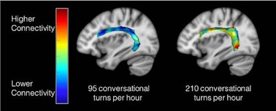 Illuminated areas of MR images illustrate white-matter connections between two key language regions in the brain and the effect adult conversation can have on children. Although both children are the same age, the same gender, and from the same socioeconomic background, they differ in the number of conversational turns experienced, which relates to the strength of white-matter connectivity in these pathways. Image courtesy of Romeo et al, Journal of Neuroscience.