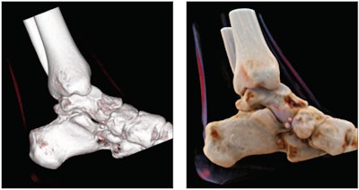 The shadowing and depth-of-field effects of the cinematically rendered image (right) minimize the distraction caused by background structures visible in the corresponding volume-rendered MR image (left). Image courtesy of AJR.