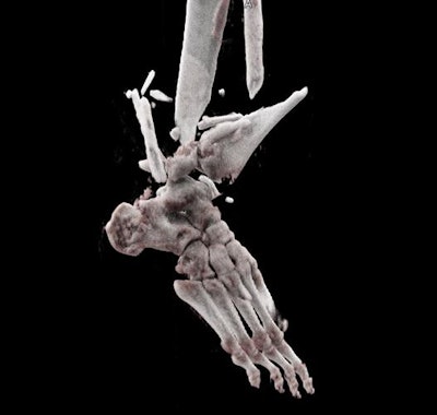 Cinematically rendered image of ankle fracture. Courtesy of Dr. Wolf Schweitzer from the University of Zurich.