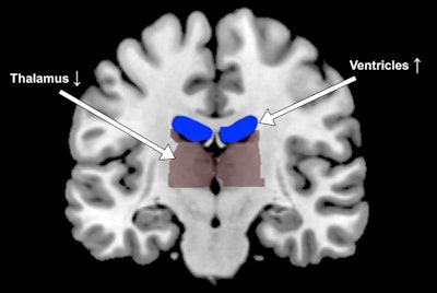 Functional MRI shows expanded ventricles and more compact thalamus in the brain of a dehydrated subject. Image courtesy of Georgia Tech.