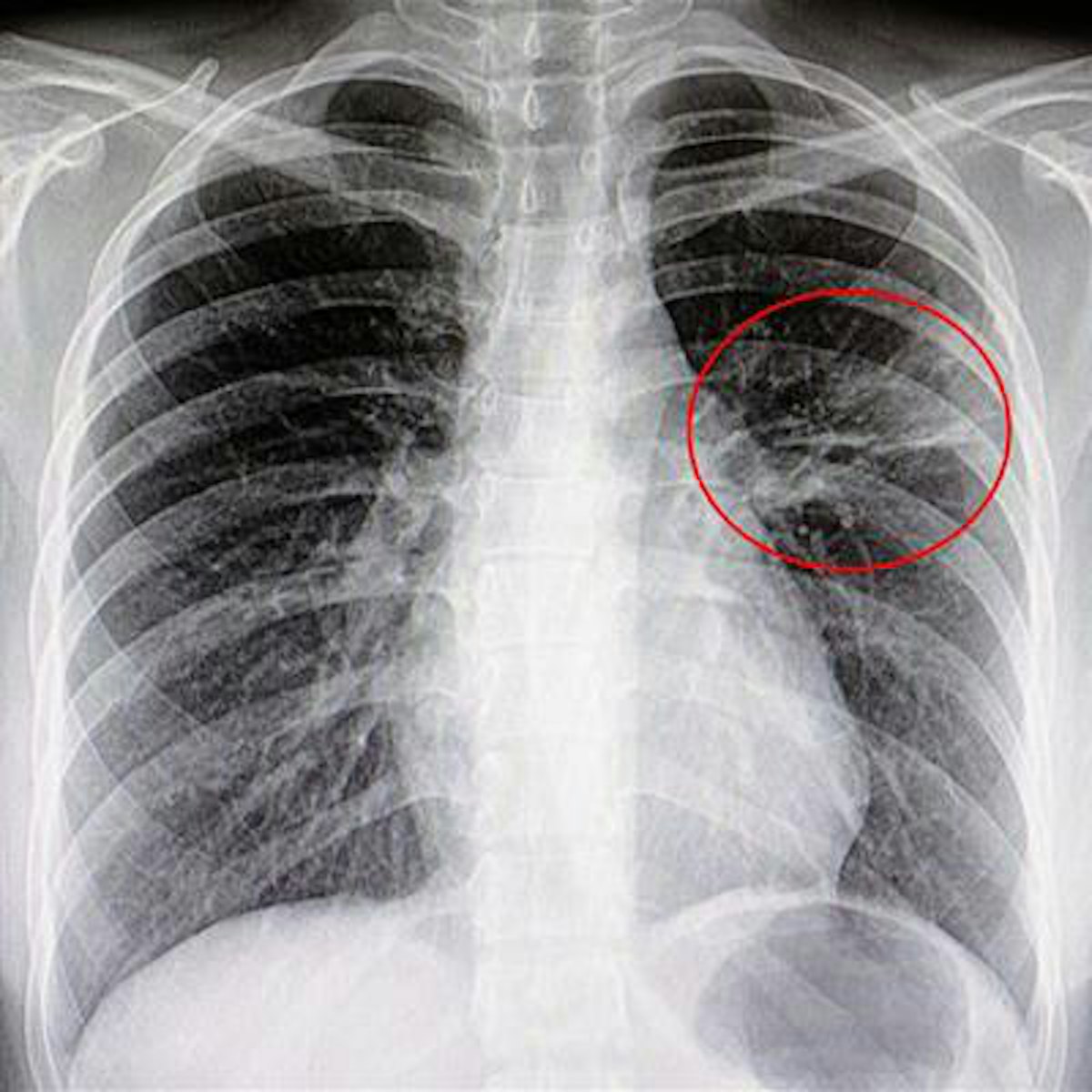 RSNA launches AI challenge to detect pneumonia on x-rays | AuntMinnie