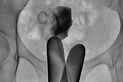 2018 08 28 23 35 1179 Endometrioma 20180828234553