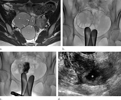 Clinical course of a 27-year-old woman with primary ovarian endometrioma presenting with dysmenorrhea. (a) Axial T2-weighted image reveals an 8.4-cm, multilocular endometrioma (*) with internal septation (arrows). (b) The endometrioma was punctured and mechanical breakdown of the internal septa was performed. (c) A catheter was inserted and contrast was injected to observe any leakage. (d) Follow-up ultrasound six months after catheter-directed sclerotherapy shows markedly decreased endometrioma (*). Images and captions courtesy of RSNA.