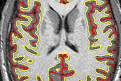 2018 08 29 19 57 8628 Ms Drug Mri Nejm 20180829190737