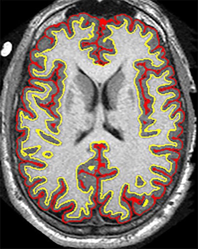 The trial results suggest that the anti-inflammatory drug ibudilast may slow brain atrophy caused by progressive MS. Image courtesy of Dr. Robert Fox and the Cleveland Clinic.