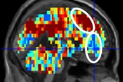 2018 08 30 17 53 2339 Carnegie F Mri Suicidal 400
