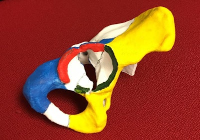 Color-coded 3D-printed hip model with an acetabular fracture. Image courtesy of Dr. Omer Awan.
